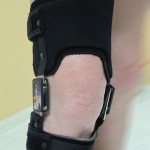l'orthèse OdrA est un moyen souvent efficace pour soulager les personnes souffrant d'arthrose du genou
